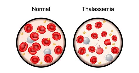 beta thalassemia anemia|Beta Thalassemia Trait: Minor vs Major, Symptoms, .